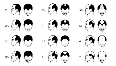 Male Pattern Baldness