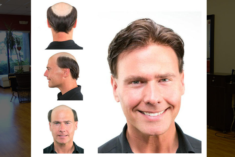 Before and After Hair Replacement for Men