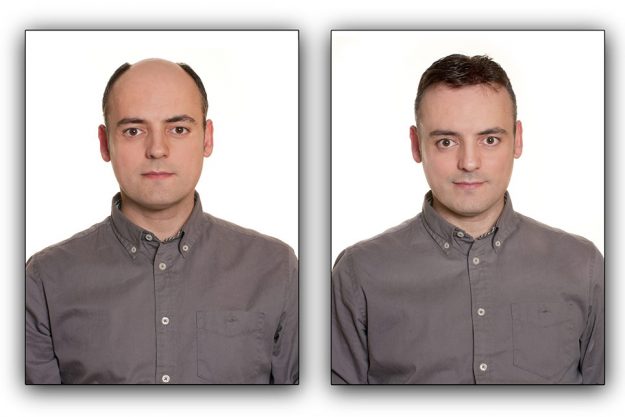 Before and After Men's Hair Replacement