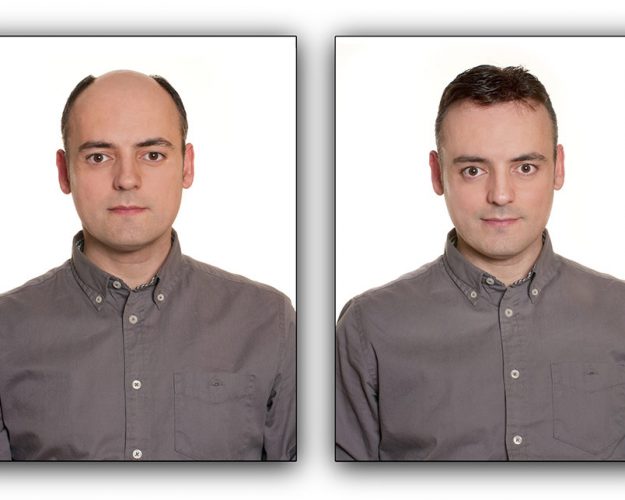 Before and After Men's Hair Replacement