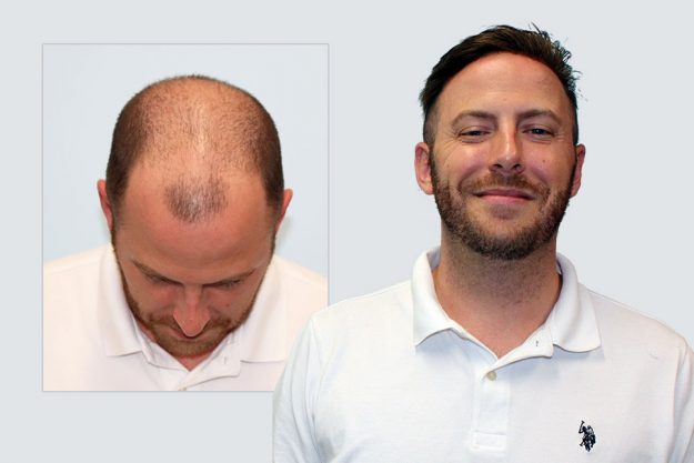 My Choice Hair Hair Replacement for Men Alex 1