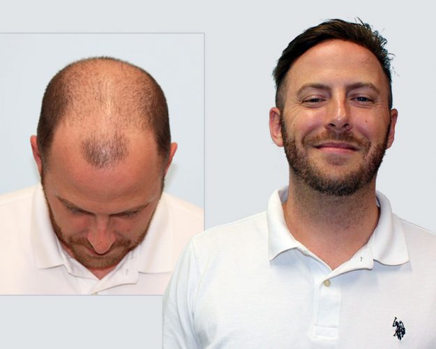 My Choice Hair Hair Replacement for Men Alex 1