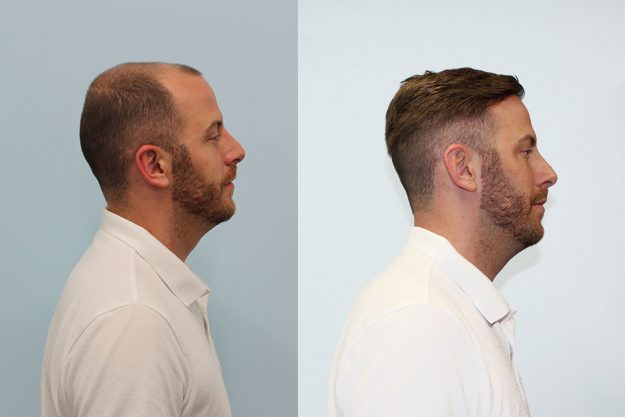 My Choice Hair Hair Replacement for Men Alex 2